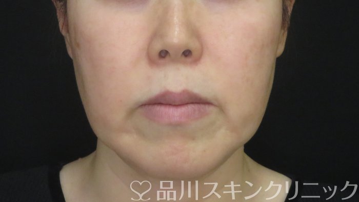 症例NO.72908のBEFORE写真