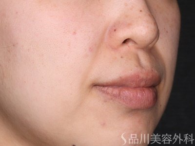 症例NO.73256のBEFORE写真