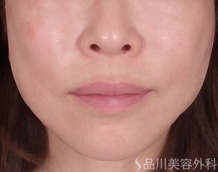 症例NO.70367のAFTER写真