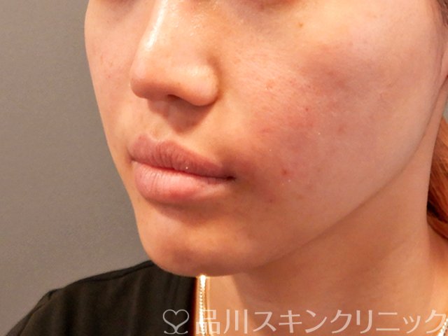 症例NO.70029のAFTER写真
