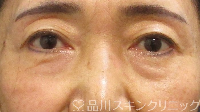 症例NO.69385のBEFORE写真