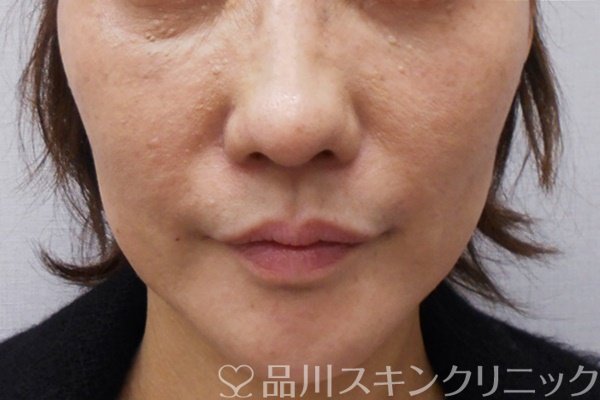 症例NO.69671のBEFORE写真