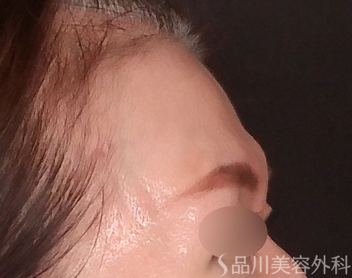 症例NO.70526のBEFORE写真