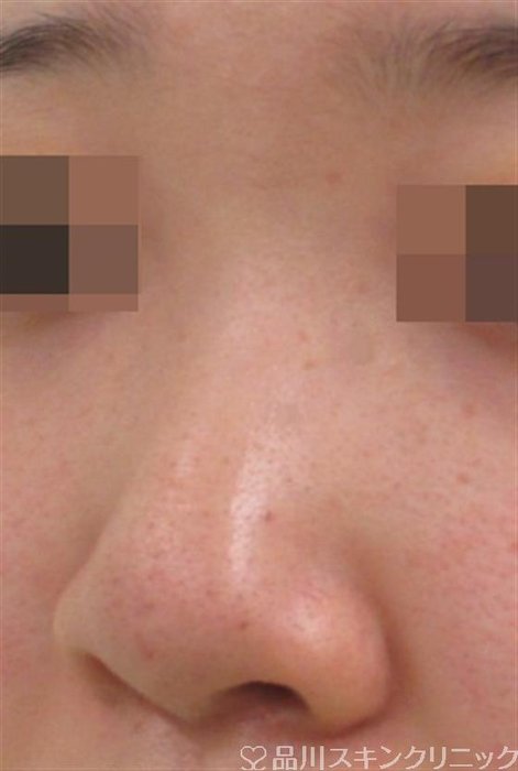 症例NO.29161のBEFORE写真