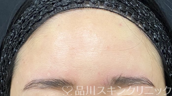 症例NO.74384のAFTER写真