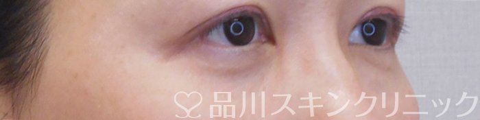 症例NO.71660のAFTER写真