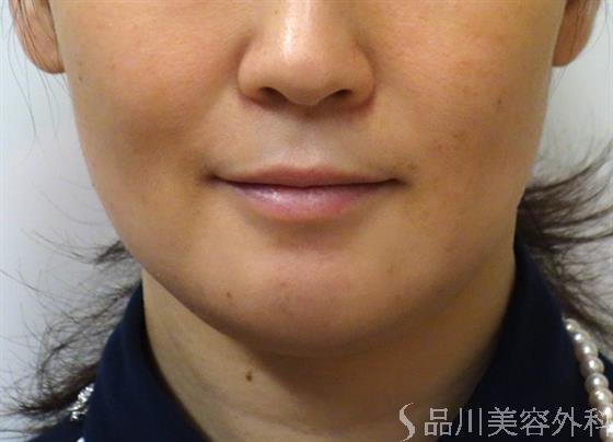 症例NO.37674のBEFORE写真