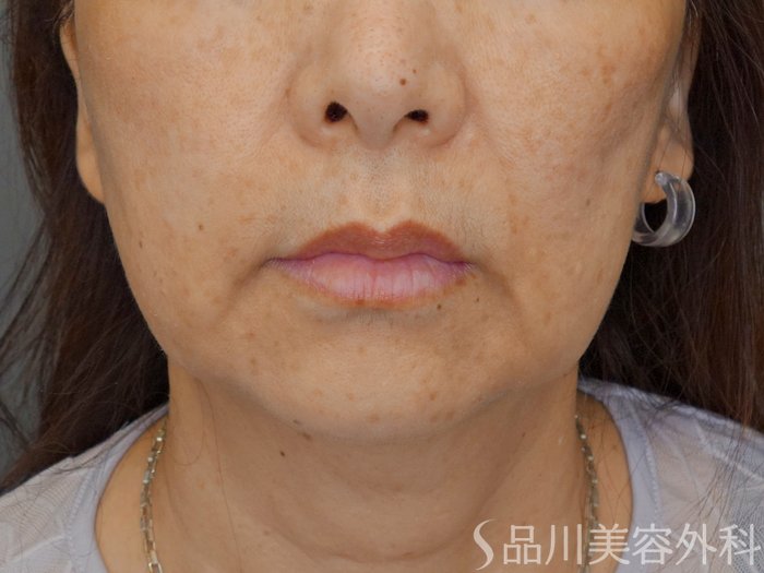 症例NO.70472のBEFORE写真