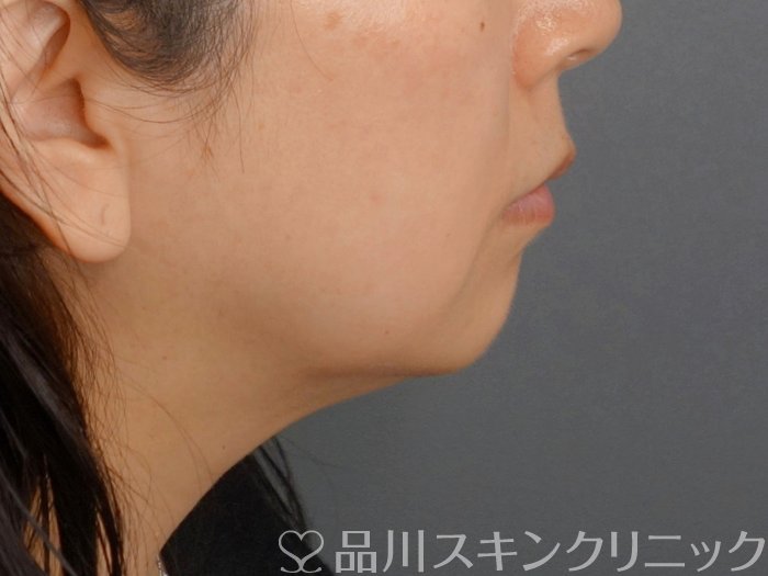 症例NO.74239のBEFORE写真