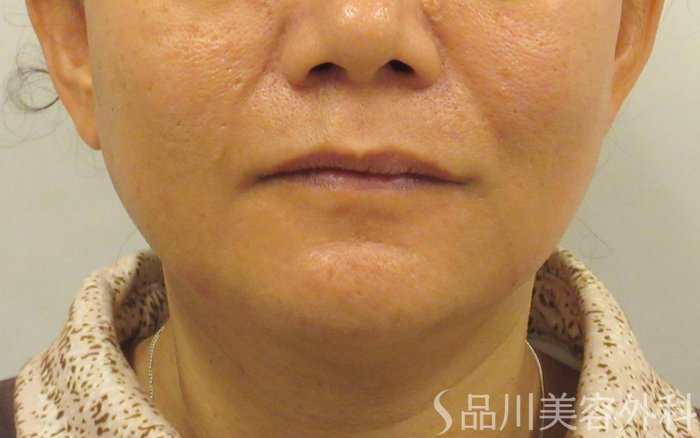 症例NO.73123のAFTER写真