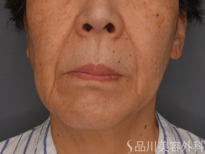症例NO.65364のBEFORE写真