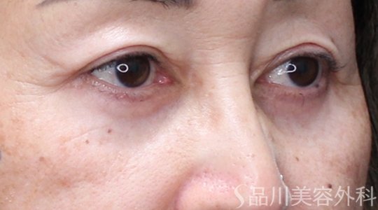 症例NO.73540のAFTER写真