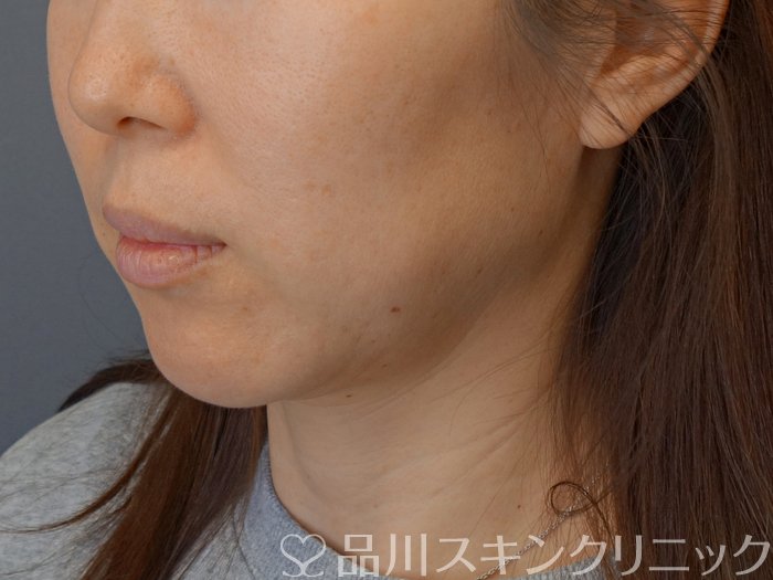 症例NO.72736のBEFORE写真