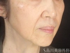 症例NO.73849のBEFORE写真