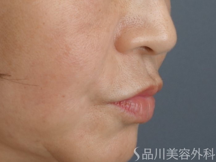 症例NO.72722のAFTER写真
