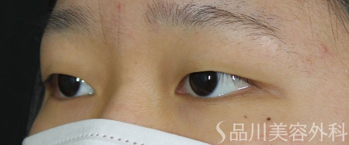 症例NO.71892のBEFORE写真