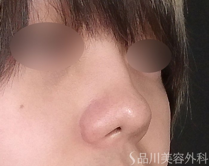 症例NO.71424のBEFORE写真