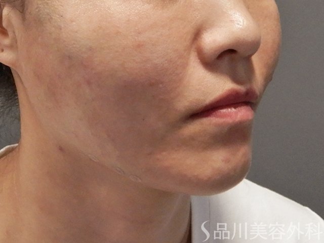 症例NO.71830のAFTER写真