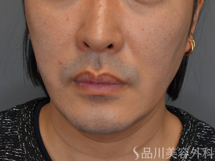症例NO.73963のBEFORE写真