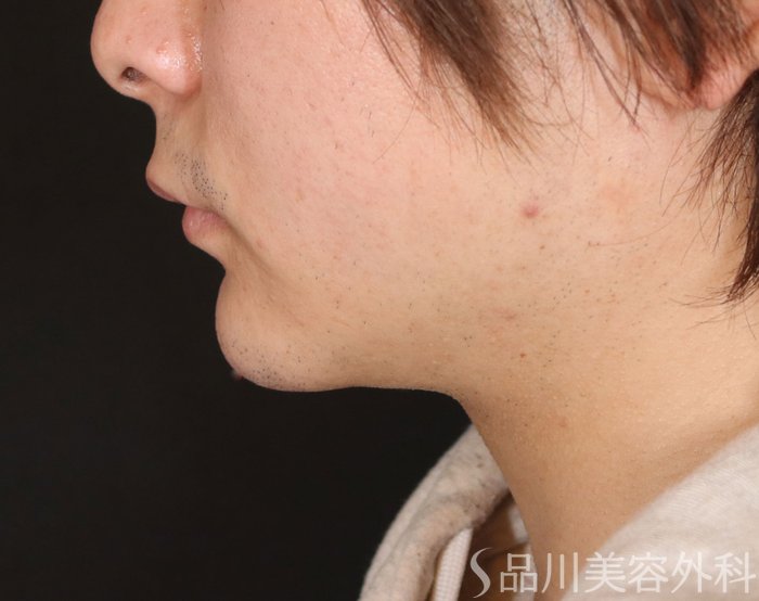 症例NO.72750のAFTER写真