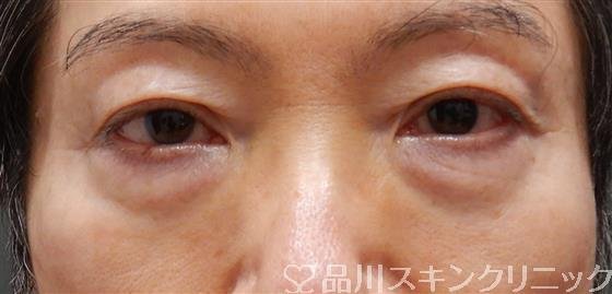 症例NO.56123のBEFORE写真
