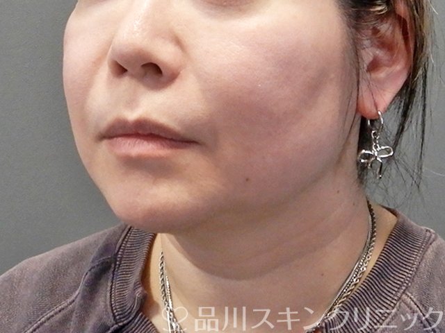 症例NO.69232のBEFORE写真