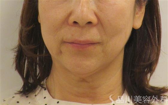 症例NO.60389のBEFORE写真
