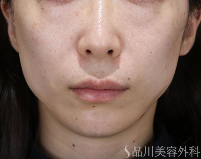 症例NO.72534のAFTER写真