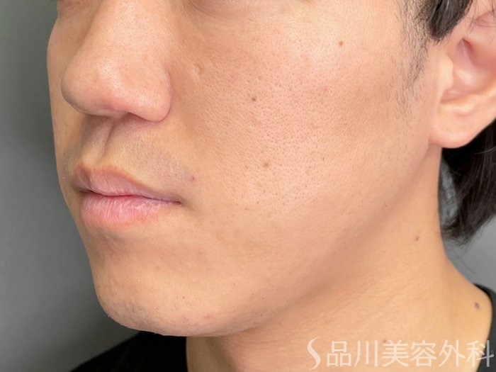 症例NO.73657のBEFORE写真