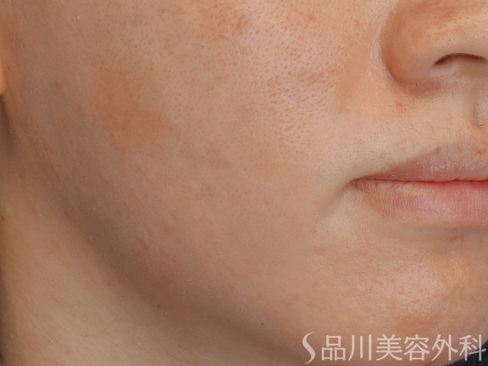 症例NO.72449のAFTER写真