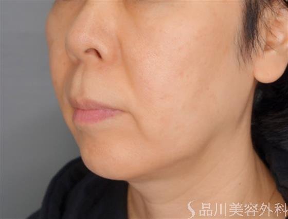 症例NO.55006のBEFORE写真