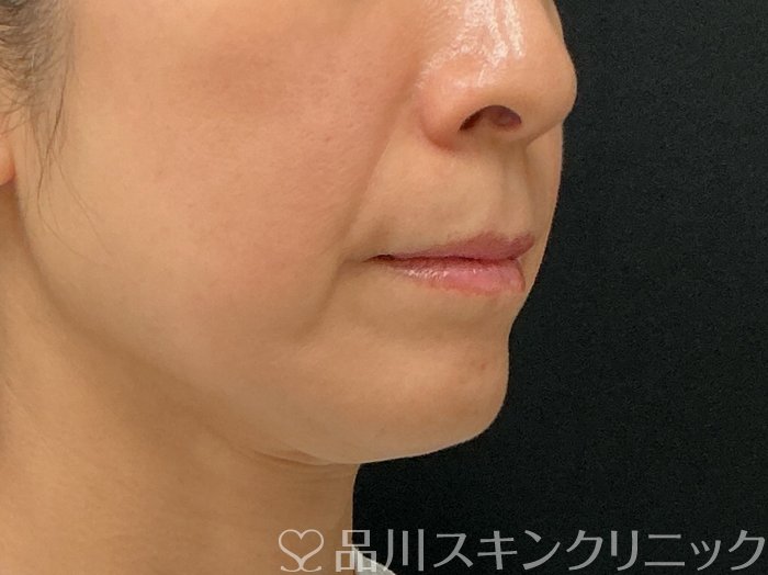 症例NO.74888のBEFORE写真