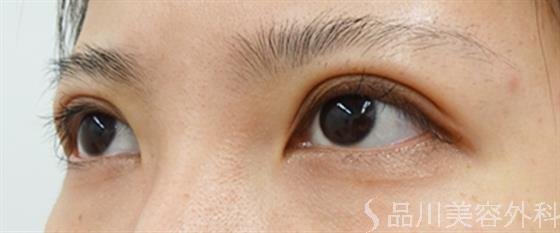 症例NO.46735のAFTER写真