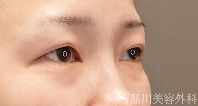 症例NO.75158のBEFORE写真