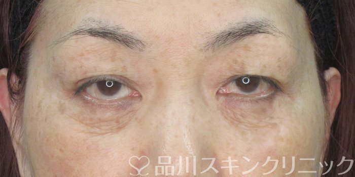 症例NO.73547のAFTER写真