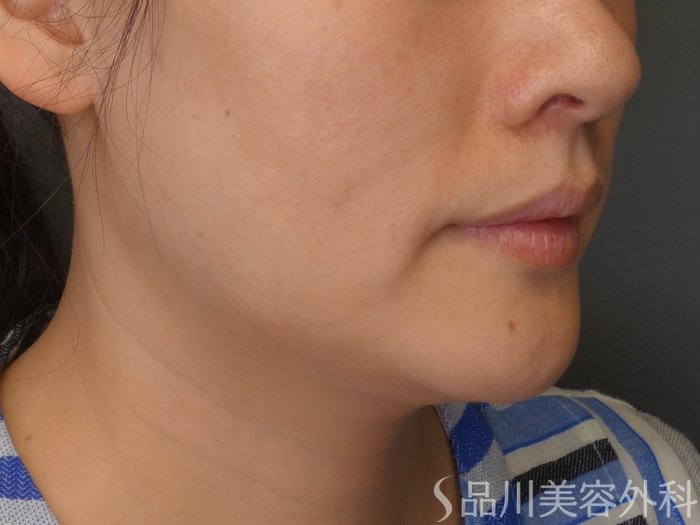 症例NO.65254のBEFORE写真