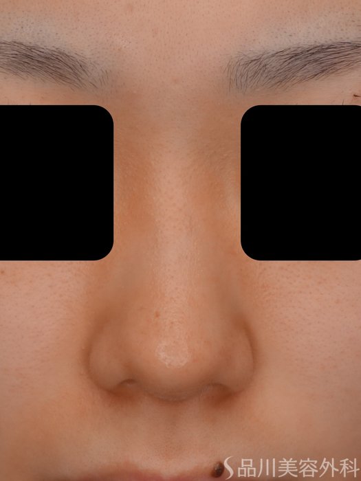 症例NO.73593のBEFORE写真