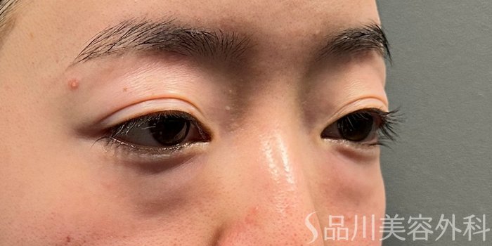 症例NO.72838のBEFORE写真