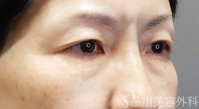 症例NO.70529のBEFORE写真