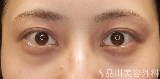 症例NO.74433のBEFORE写真