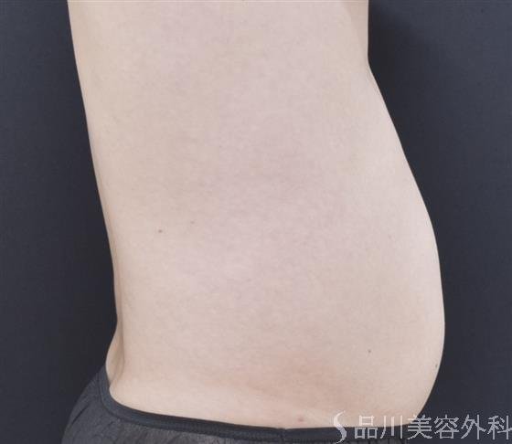 症例NO.44243のBEFORE写真
