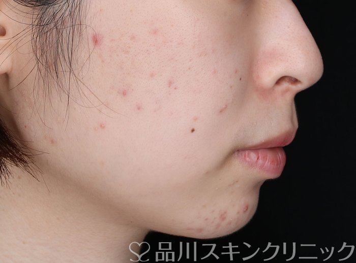症例NO.65176のBEFORE写真