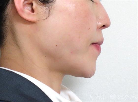 症例NO.27463のAFTER写真