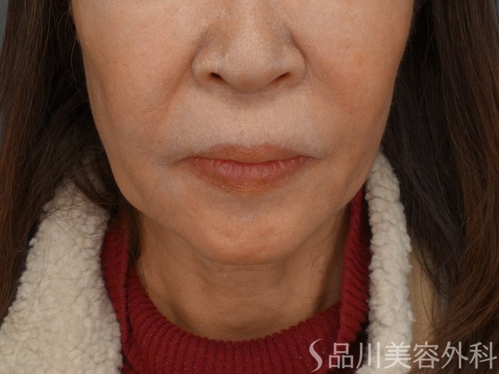 症例NO.74454のBEFORE写真