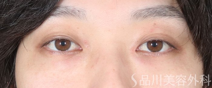 症例NO.73562のBEFORE写真