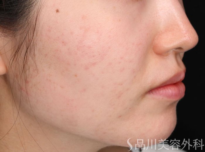 症例NO.72876のAFTER写真