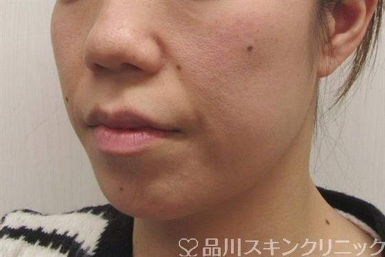 症例NO.57877のBEFORE写真