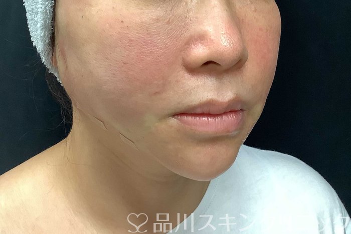 症例NO.69917のAFTER写真