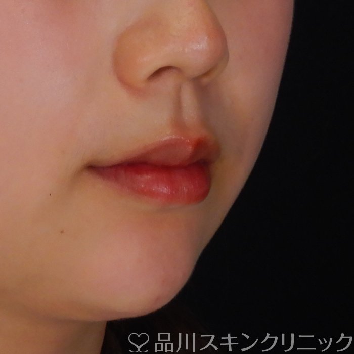 症例NO.69764のAFTER写真