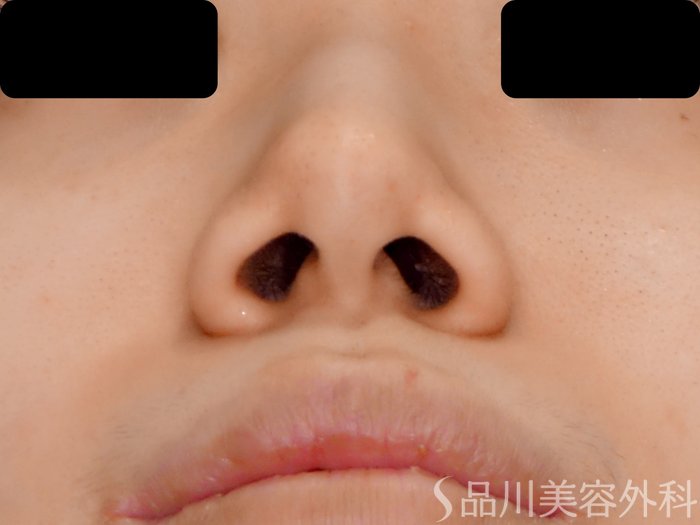 症例NO.70116のBEFORE写真